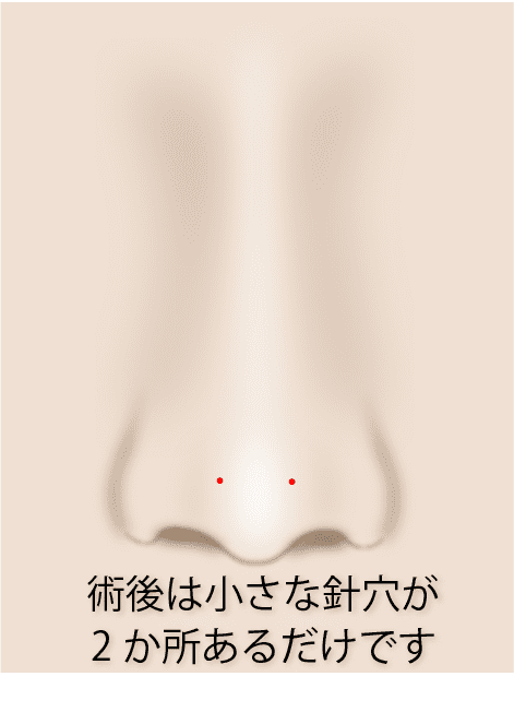 ④表面の傷は針穴のみ